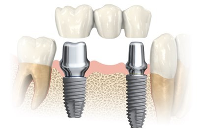 coroana pe implant